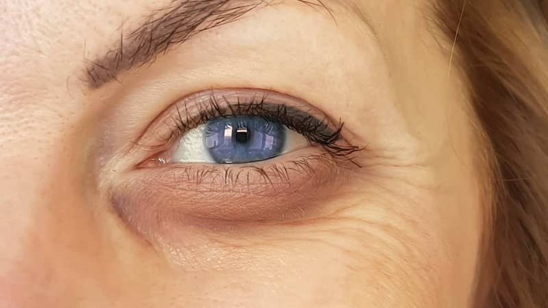 Vùng da quanh mắt bị khô ngứa là bệnh gì?3