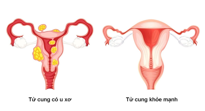 Vùng hạ vị nằm ở đâu? Bị đau vùng hạ vị cảnh báo điều gì? 4
