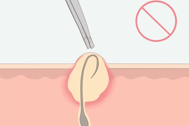 Wax lông bị lông mọc ngược phải làm sao? 3