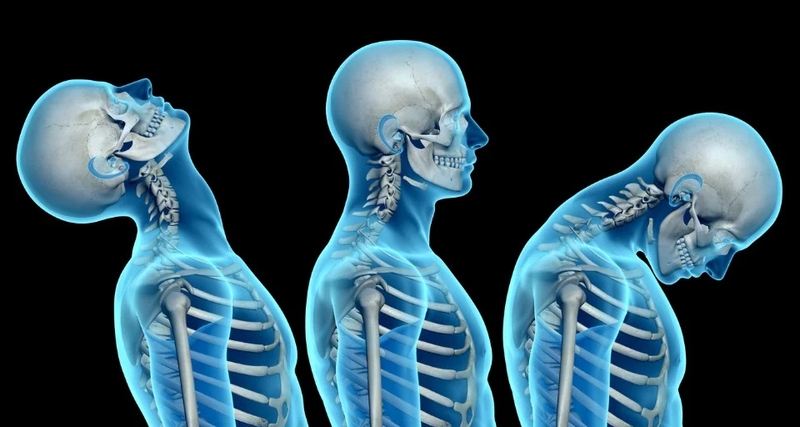 Whiplash là gì? Nguyên nhân, triệu chứng của chấn thương do giật cổ