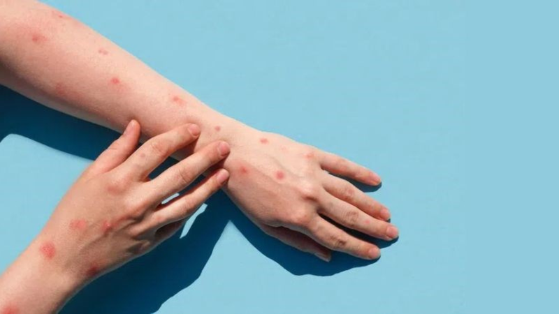 WHO bổ sung vắc-xin MVA-BN vào danh sách tiền thẩm định là vắc-xin đầu tiên chống lại bệnh mpox 1