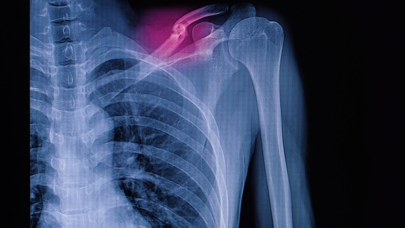Hình ảnh X-quang xương đòn bị gãy sẽ như thế nào? 3