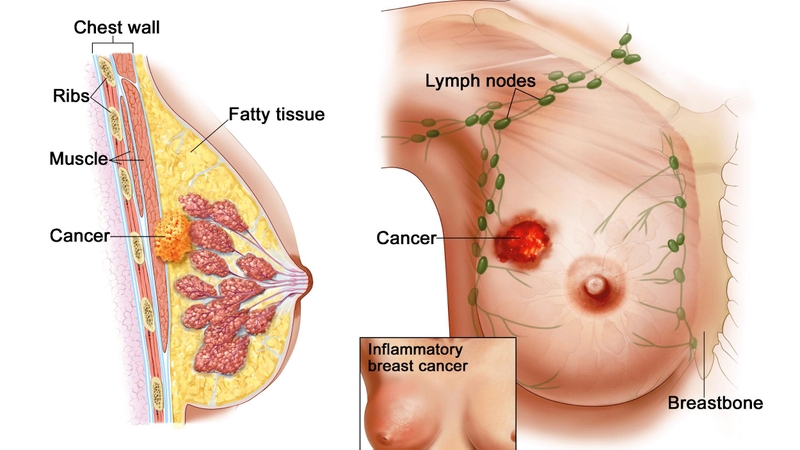 Xạ trị proton là gì? Bệnh nhân ung thư nào được chỉ định xạ trị proton? 4