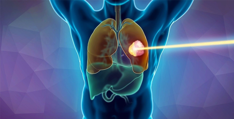 Xạ trị ung thư phổi sống được bao lâu?2