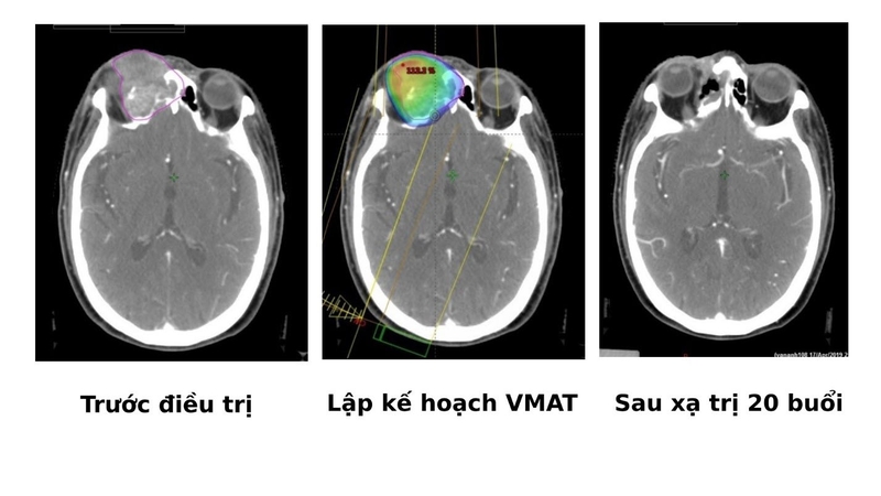 Xạ trị VMAT là gì? Đối tượng chỉ định là những ai? 3