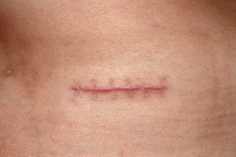 Xác định chính xác dấu hiệu bục vết mổ đẻ bên trong nhiều bà mẹ đang quan tâm