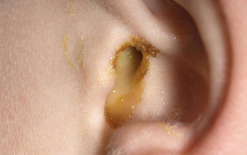 Xẹp nhĩ là gì? Mức độ nguy hiểm và cách điều trị như thế nào? 1