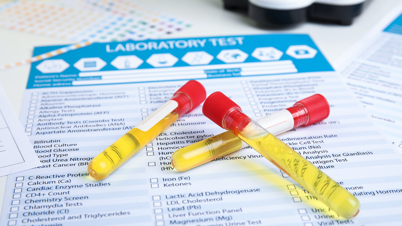 Xét nghiệm 4 chất gây nghiện bạn cần biết