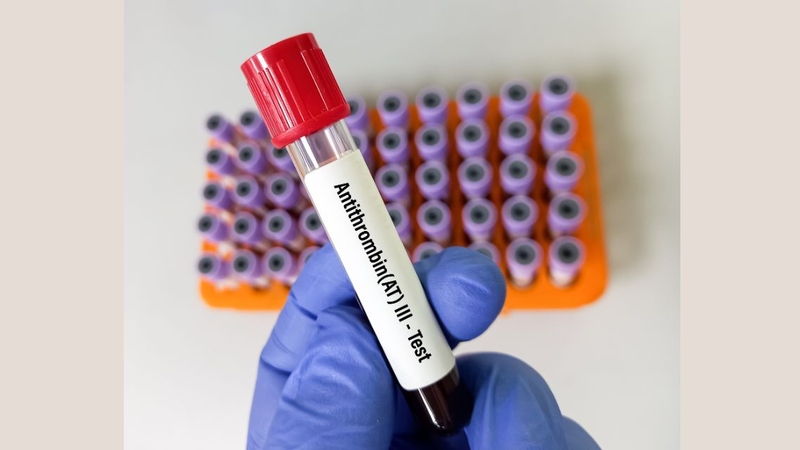 Nên xét nghiệm Antithrombin III ở cơ sở y tế uy tín để đảm bảo độ chính xác
