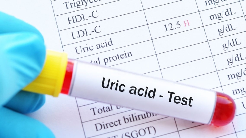 Xét nghiệm acid uric máu nên được thực hiện định kỳ ở người có nguy cơ cao
