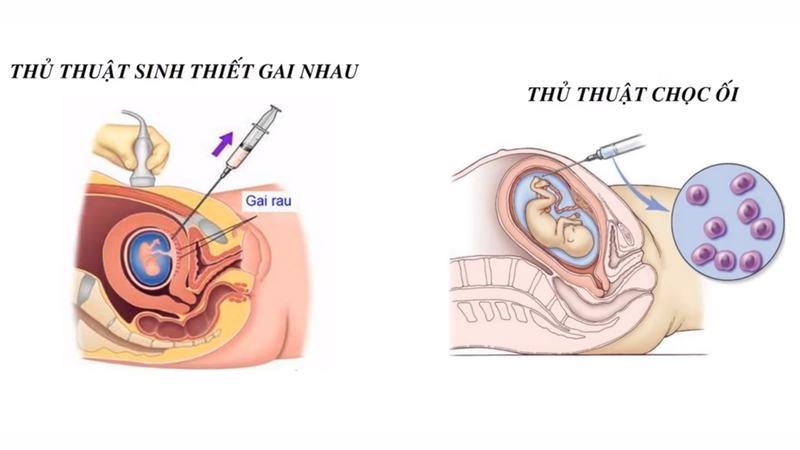 Xét nghiệm ADN thai nhi bằng cách nào? Cách nào an toàn cho mẹ và bé 3