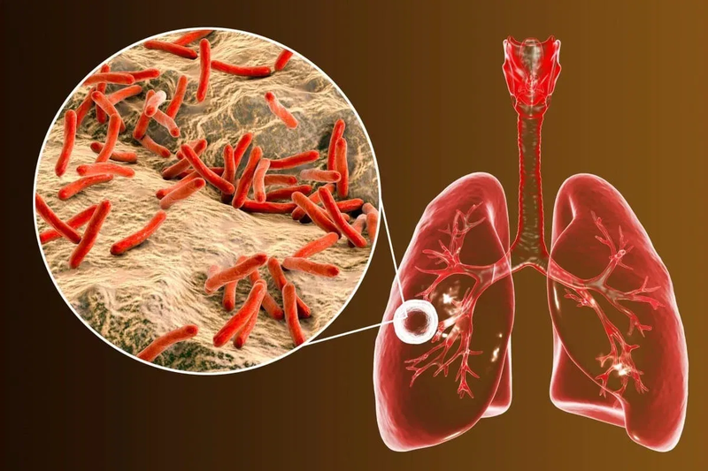 AFB là một trong những xét nghiệm chẩn đoán bệnh lao phổi