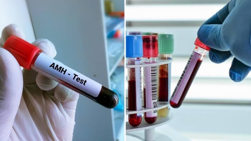 Phương pháp kiểm tra nồng độ hormone Anti-Mullerian trong máu là xét nghiệm AMH