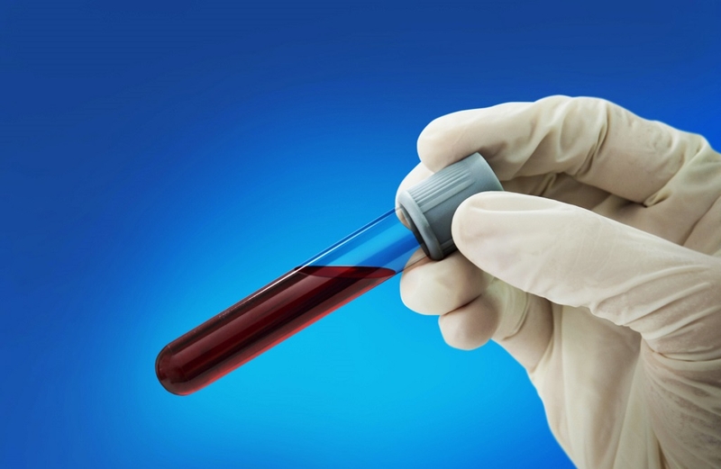 Xét nghiệm Beta2 Microglobulin là gì? Vai trò quan trọng của xét nghiệm 3