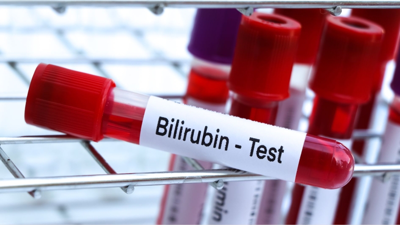 Xét nghiệm Bilirubin nhằm đánh giá chức năng gan, mật