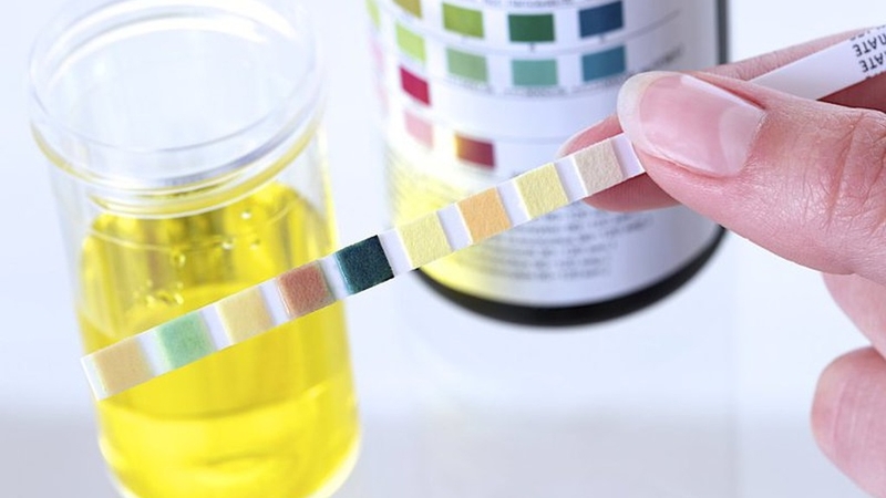 Xét nghiệm cặn addis: Phương pháp chẩn đoán hội chứng thận hư hiệu quả 1