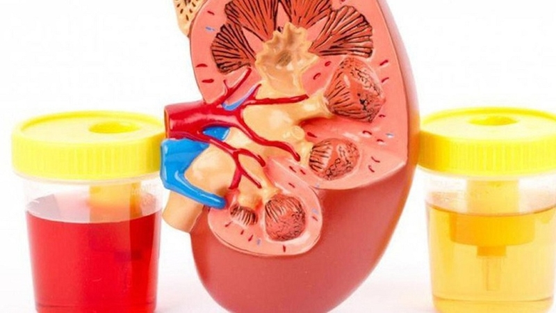 Xét nghiệm cặn addis: Phương pháp chẩn đoán hội chứng thận hư hiệu quả 2