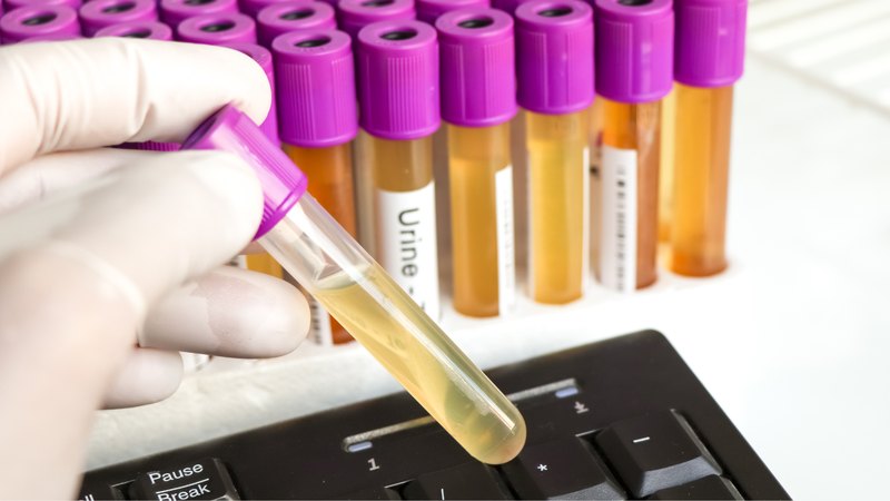 Xét nghiệm Catecholamines trong chẩn đoán y khoa 4