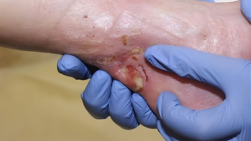 Mẫu mủ được lấy đúng kỹ thuật vô khuẩn