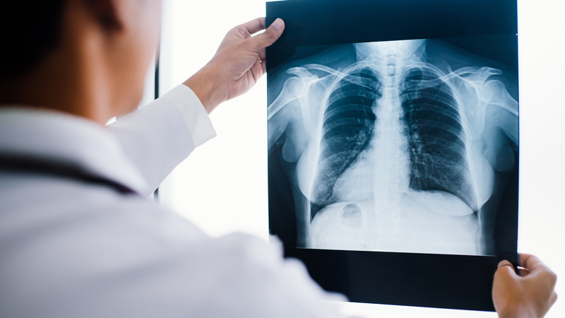 Xét nghiệm chẩn đoán lao phổi 2