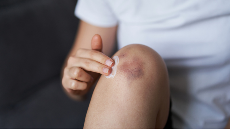 Thường xuyên bầm tím là dấu hiệu cần xét nghiệm máu