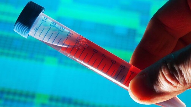 Xét nghiệm cyfra 21-1 thường dùng trong chẩn đoán bệnh lý nào? 3