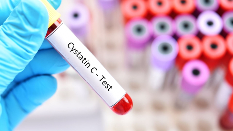 Xét nghiệm Cystatin C có ý nghĩa gì đối với sức khỏe thận? 2
