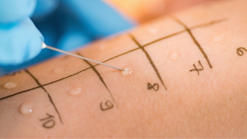 Bệnh viện Đại học Y Dược TP.HCM áp dụng test lẩy da và xét nghiệm IgE để hỗ trợ chẩn đoán dị ứng