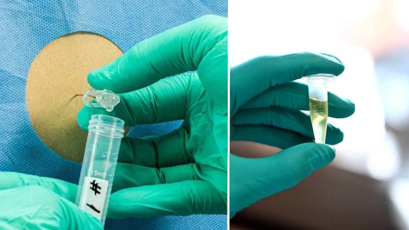 xet-nghiem-dich-nao-tuy-la-gi-quy-trinh-thuc-hien-xet-nghiem-dich-nao-tuy 1.jpg