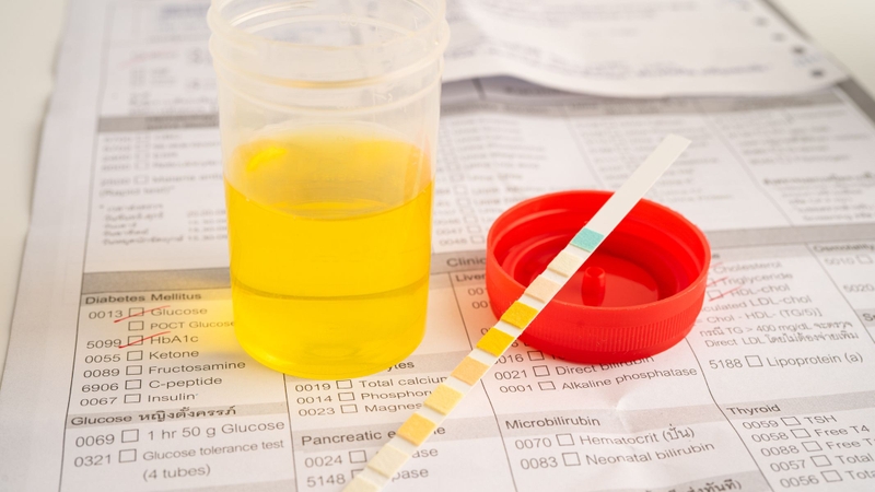 Bệnh nhân nhịn ăn qua đêm và uống khoảng 2 lít nước trước khi xét nghiệm