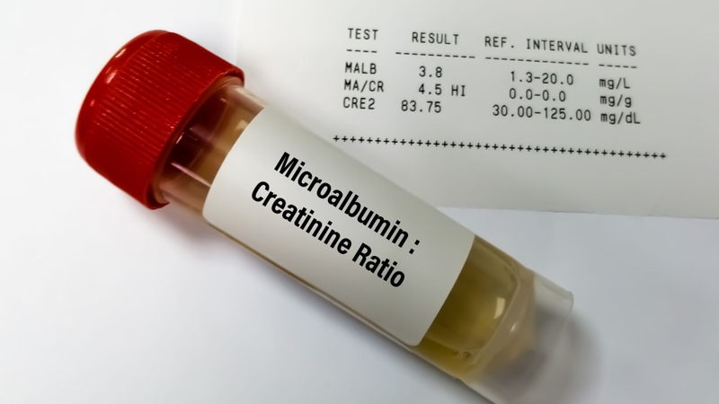 Xét nghiệm Creatinin nước tiểu đo nồng độ Creatinin trong mẫu nước tiểu thu thập trong 24 giờ