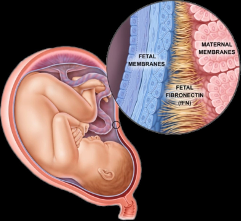 Xét nghiệm Fibronectin phát hiện nguy cơ sinh non 3