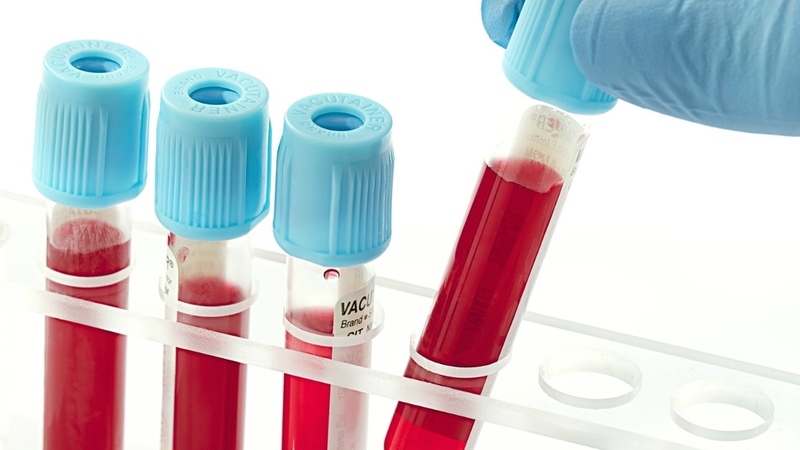 Xét nghiệm gì để biết suy thận: Tìm hiểu chi tiết 1