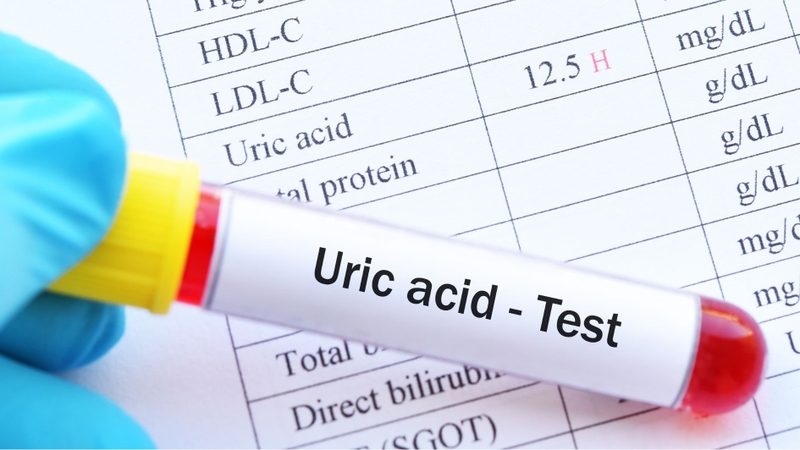 Xét nghiệm gout nhằm kiểm tra nồng độ acid uric trong cơ thể