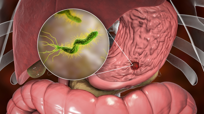 Xét nghiệm H.pylori là gì? Có tác dụng gì? 1