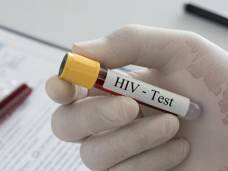 Xét nghiệm HIV khẳng định: Phương pháp xác định chính xác tình trạng nhiễm HIV 2