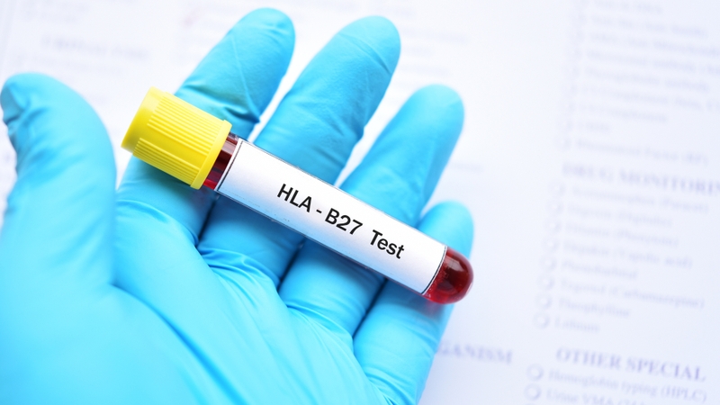 Xét nghiệm HLA là gì? Khi nào cần thực hiện xét nghiệm HLA? 4