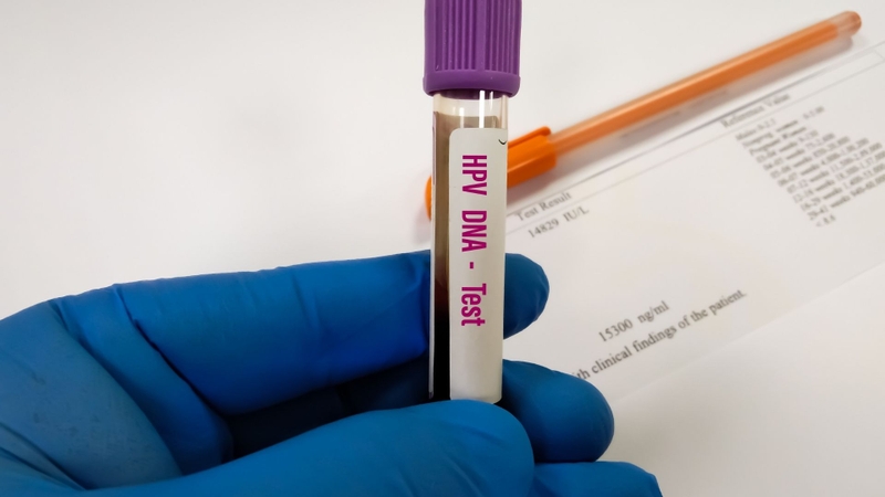 Xét nghiệm HPV DNA là phương pháp phát hiện vật liệu di truyền của HPV trong mẫu tế bào