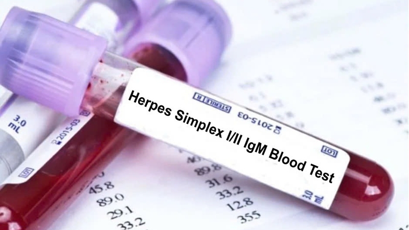 Xét nghiệm HSV – Phương pháp phát hiện bệnh Herpes hiệu quả 4