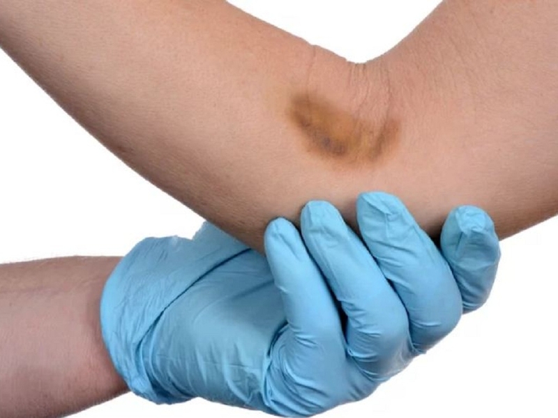 Xét nghiệm ion đồ máu là gì? Quy trình và ý nghĩa của xét nghiệm ion đồ máu