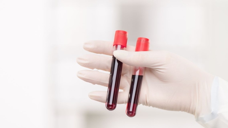 Xét nghiệm kháng đông Lupus giúp hỗ trợ đánh giá hội chứng kháng phospholipid
