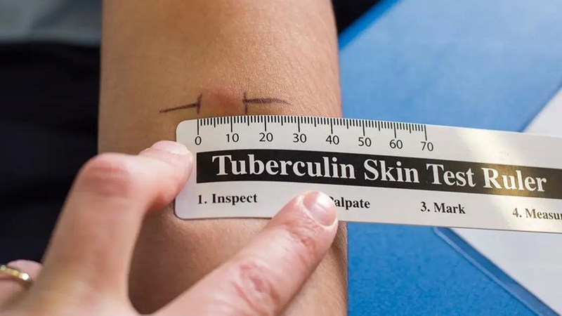 Xét nghiệm lao phổi bao nhiêu tiền&nbsp;là thông tin nhiều bệnh nhân muốn biết