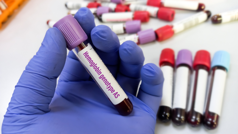 Xét nghiệm lấy máu gót chân ở trẻ sơ sinh để làm gì? 3