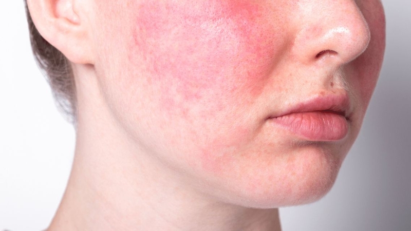 Xét nghiệm hỗ trợ chẩn đoán và đánh giá mức độ hoạt động của bệnh