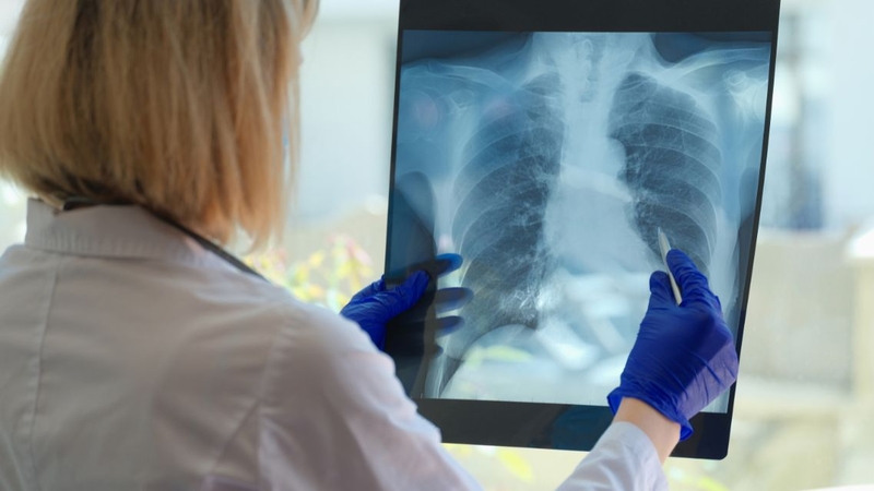 Chẩn đoán lao phổi cần kết hợp xét nghiệm đờm, hình ảnh học và đánh giá lâm sàng