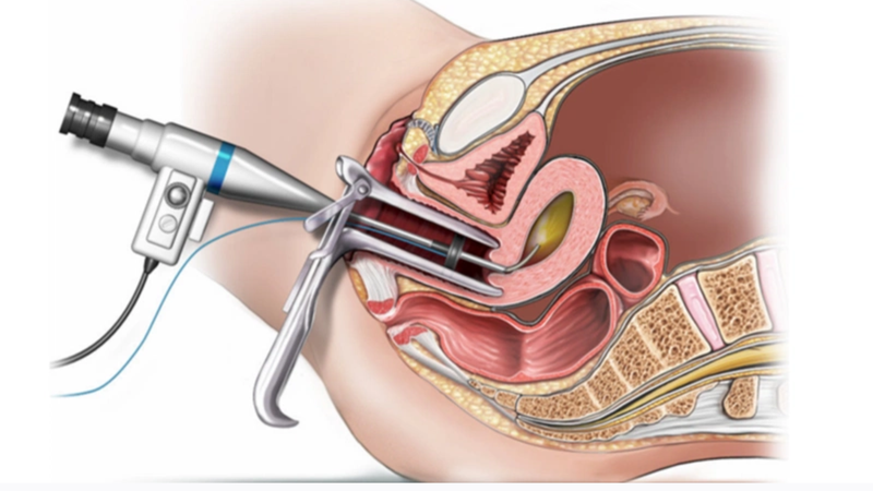 Xét nghiệm máu có phát hiện ung thư cổ tử cung không? 3