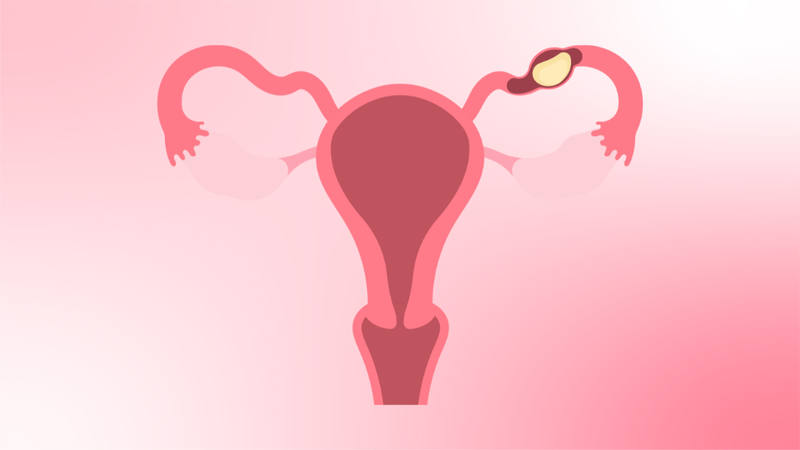 Xét nghiệm máu có thai nhưng siêu âm đầu dò không thấy là vì sao? Nguyên nhân và cách xử trí 3