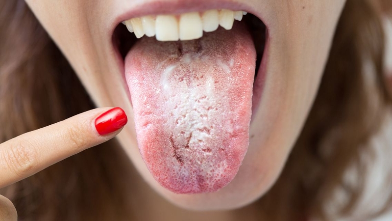 Xét nghiệm nấm Candida: Gồm những gì và khi nào cần thực hiện 1