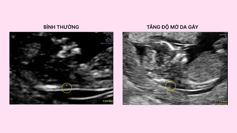 Xét nghiệm NIPT là gì? Biết được những gì và giá làm xét nghiệm? 7