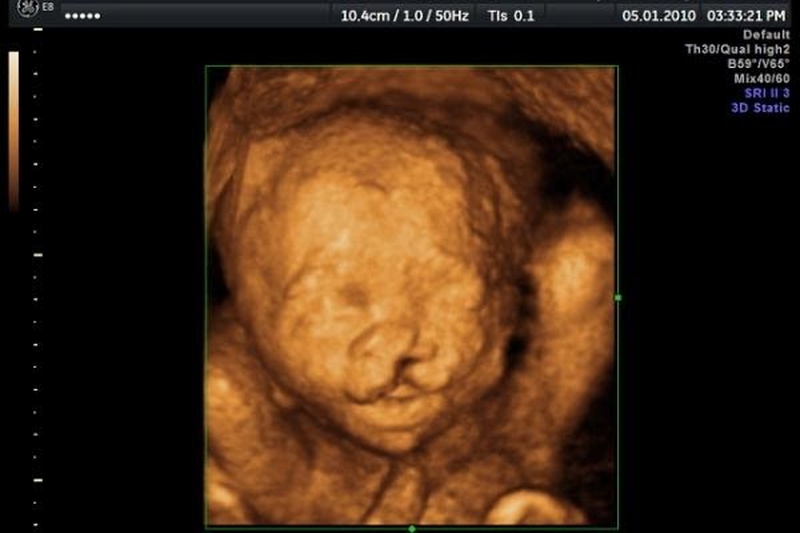 Xét nghiệm nipt từ tuần bao nhiêu là tốt nhất? 3